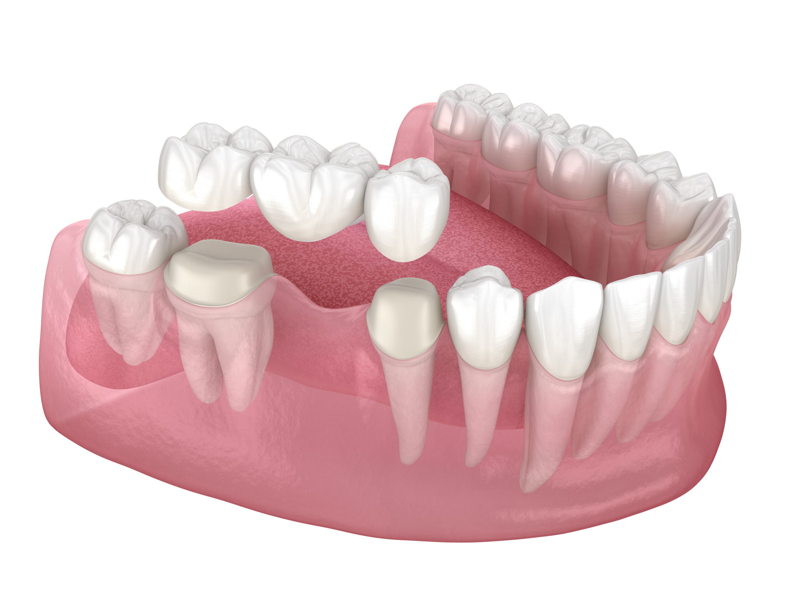 Benefits of Dental Bridges Restore Your Smile and Function