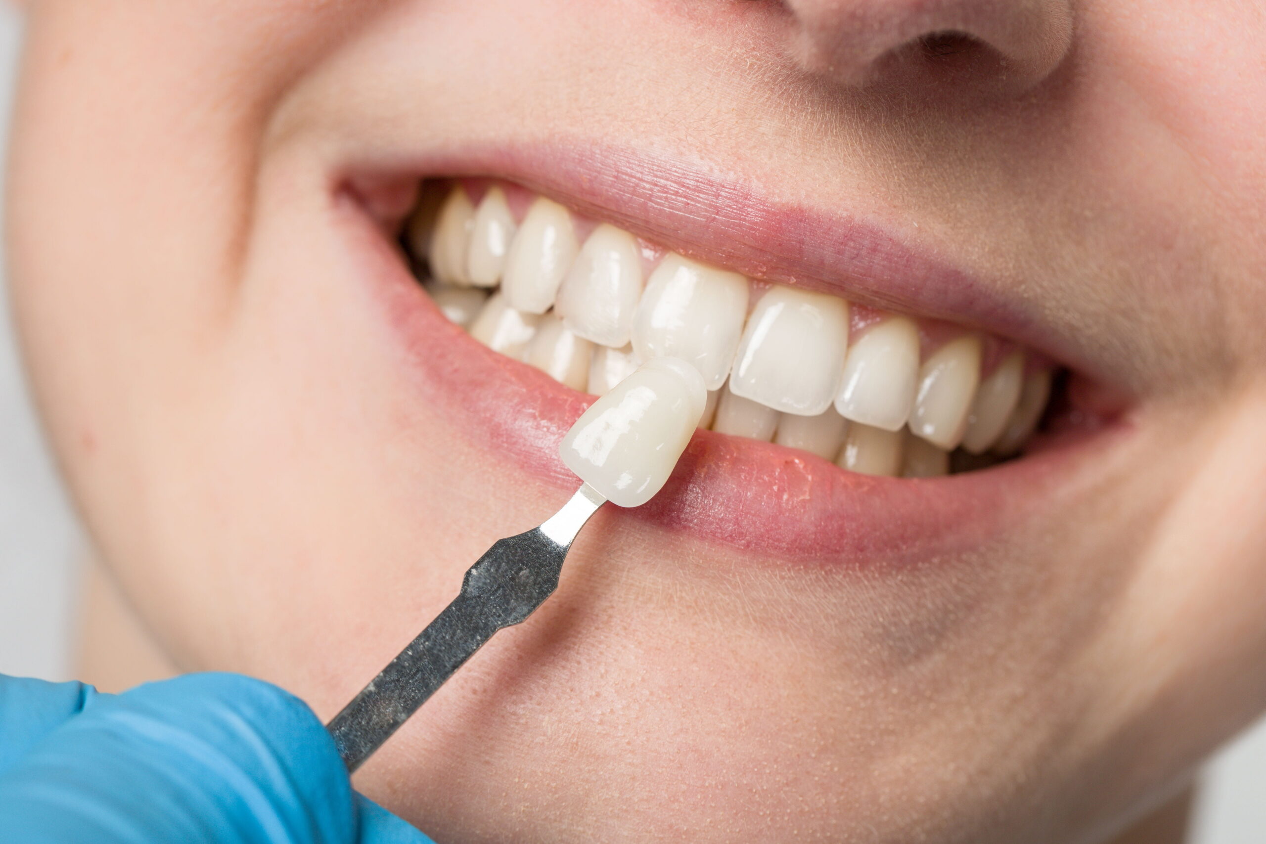 What Disqualifies a Patient From Veneers, and Who Is a Good or Bad Candidate?