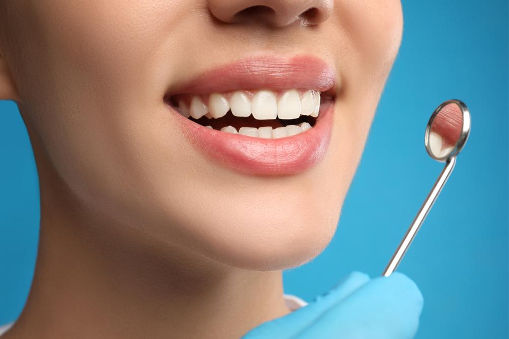 veneers